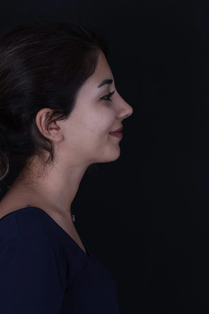 Burun Estetiği burun estetiği nedir