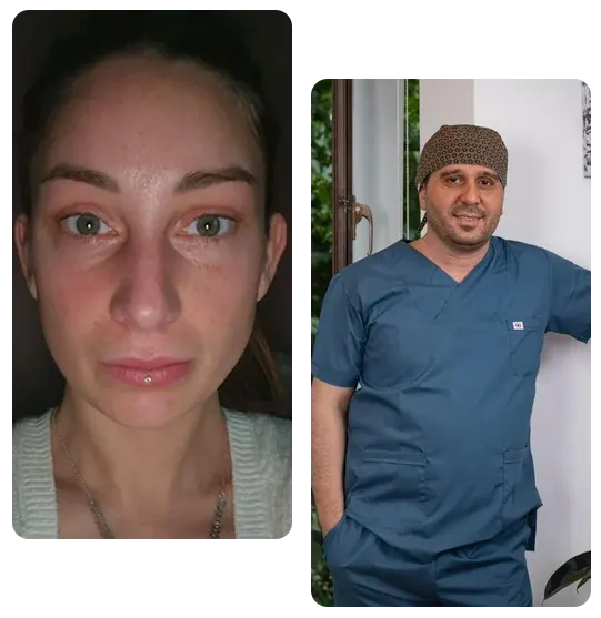 Tilki Göz Estetiği Tilki Göz Estetiği