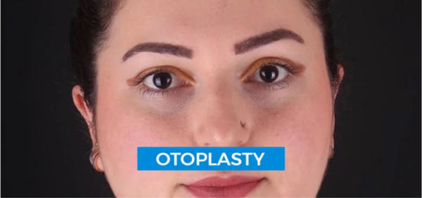 Kepçe Kulak Ameliyatı (Otoplasti) kepce-kulak-ameliyati