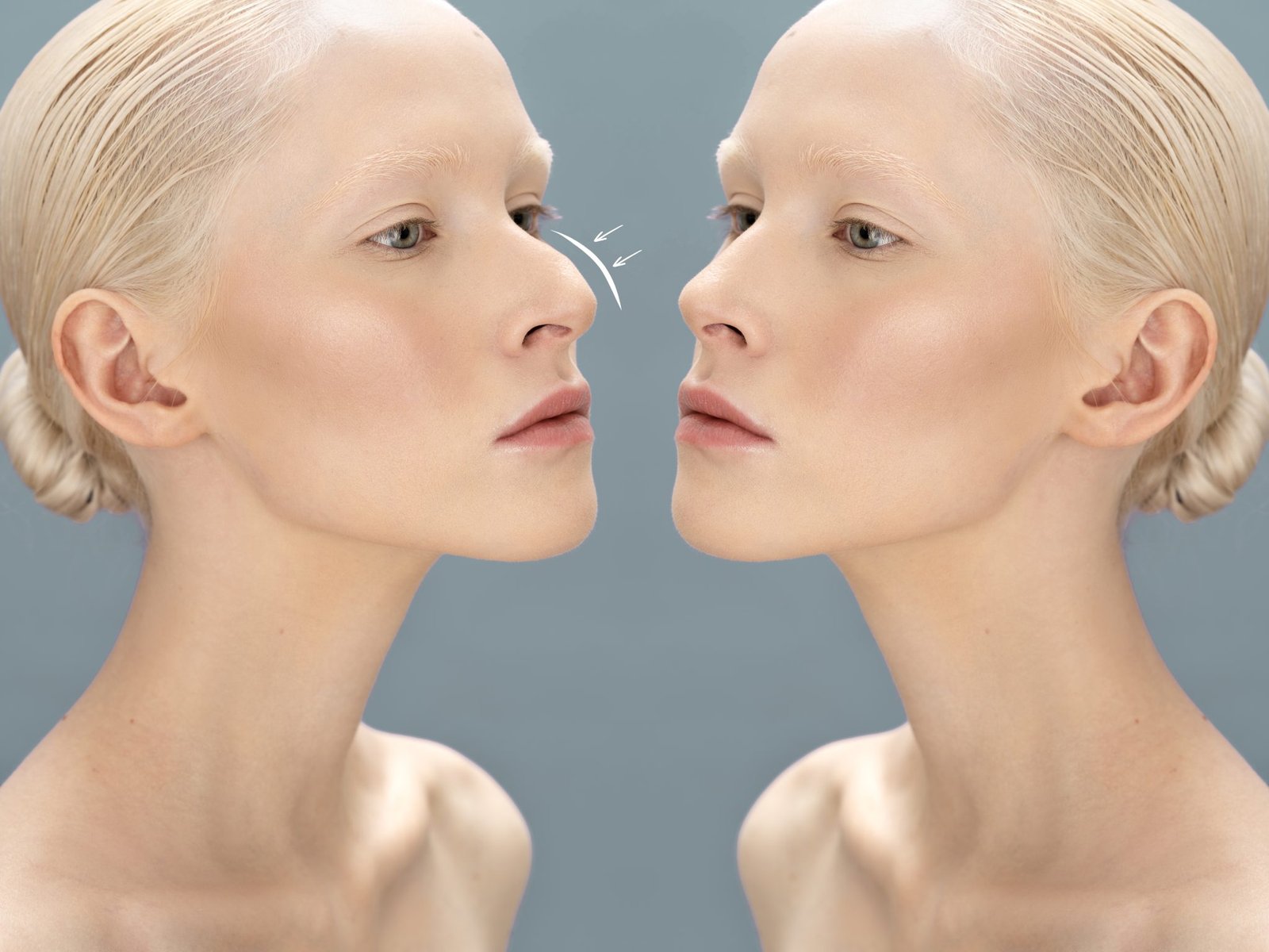 sarkik-burun-estetigi