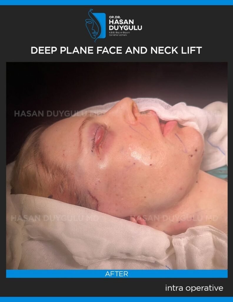 Deep-plane-face-and-necklift-with-deep-neck-contouring-with-muscle-subplatismal-fat-and-glad-s-1