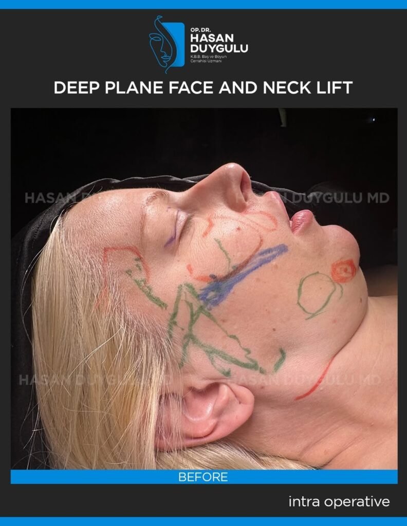 Deep-plane-face-and-necklift-with-deep-neck-contouring-with-muscle-subplatismal-fat-and-glad-s