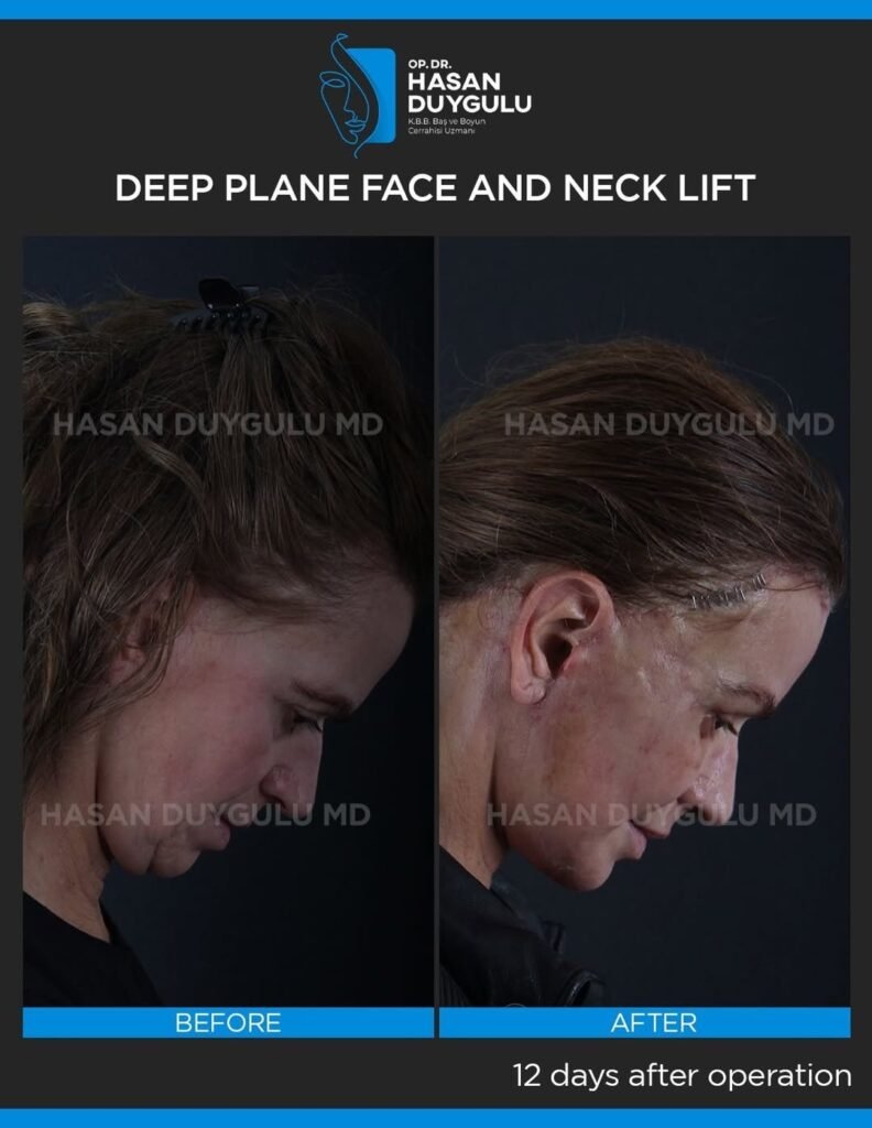 This-lovely-patient-applied-to-me-for-facial-rejuvenation.-We-performed-a-deep-plane-face-and-ne-3