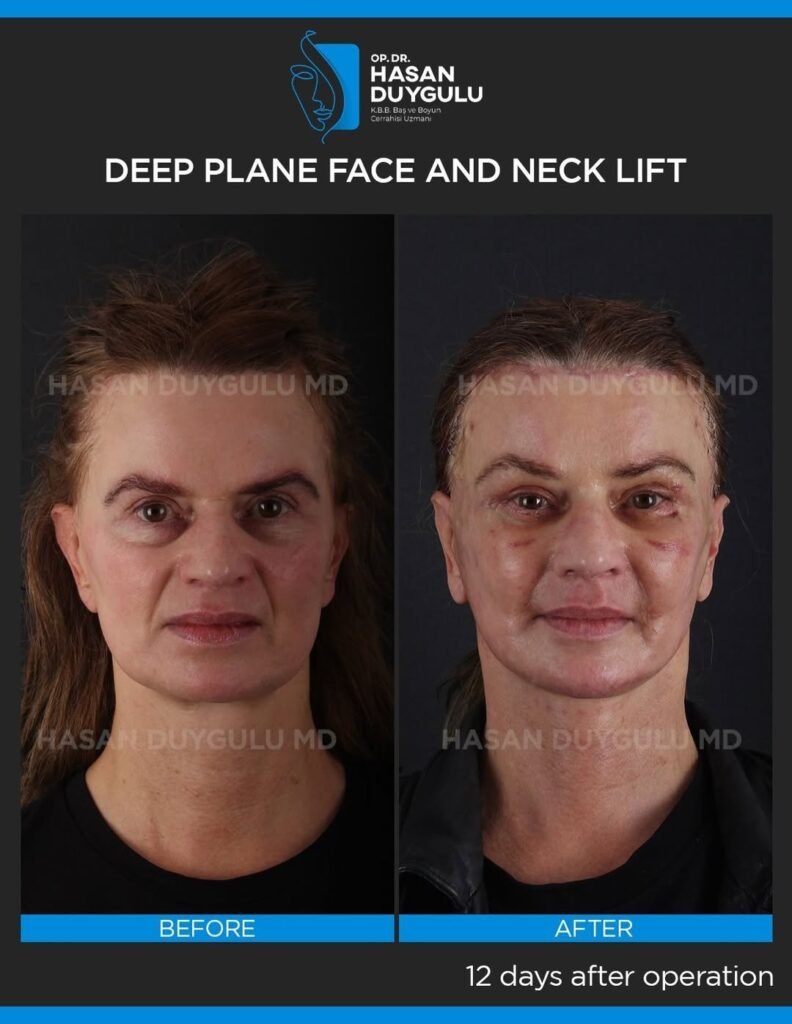 This-lovely-patient-applied-to-me-for-facial-rejuvenation.-We-performed-a-deep-plane-face-and-ne