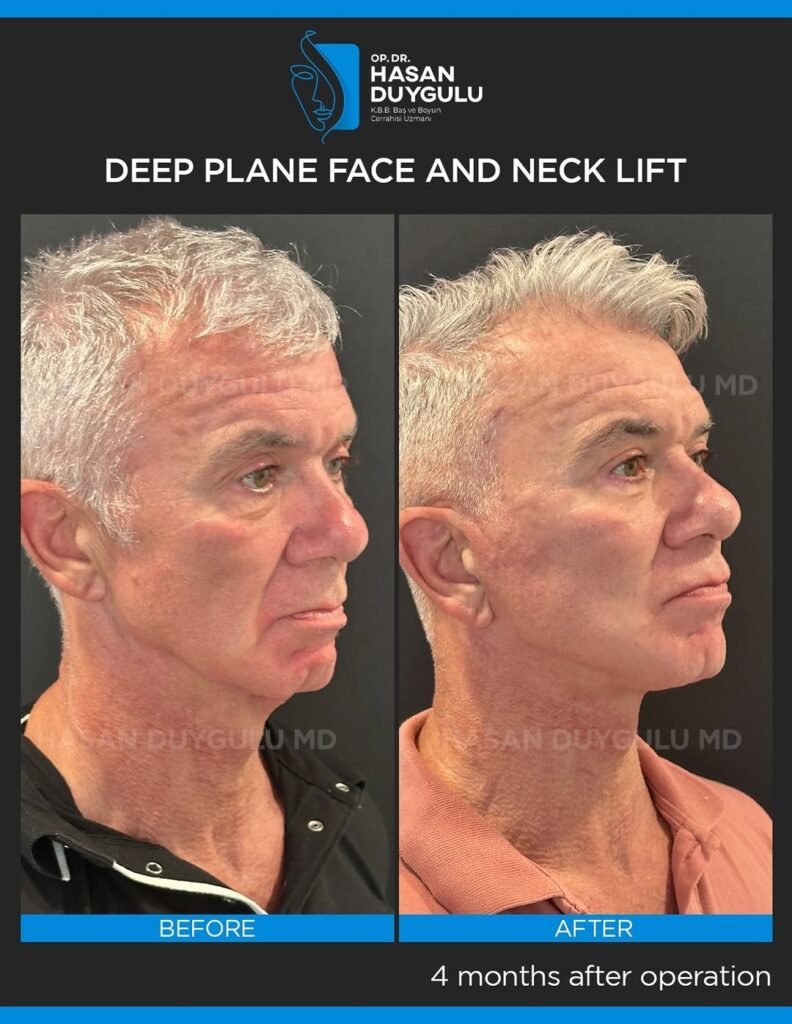 This-patient-consulted-me-4-months-ago-for-facial-rejuvenation-surgery.We-performed-deep-plane-f-1