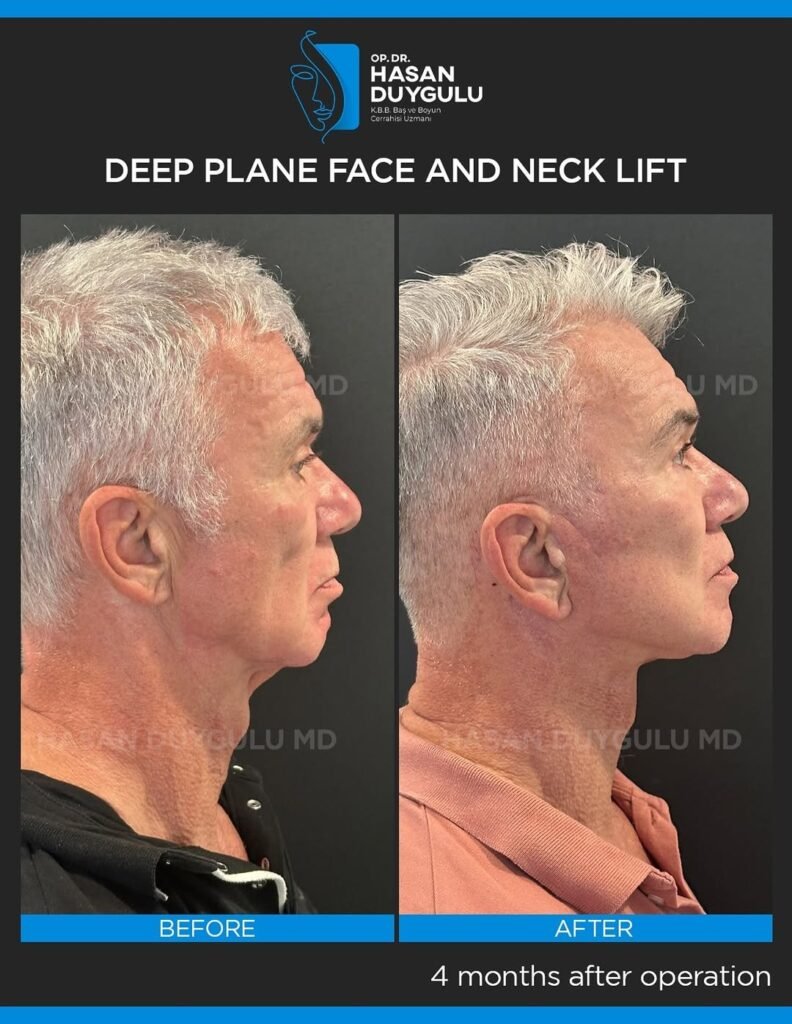 This-patient-consulted-me-4-months-ago-for-facial-rejuvenation-surgery.We-performed-deep-plane-f-2