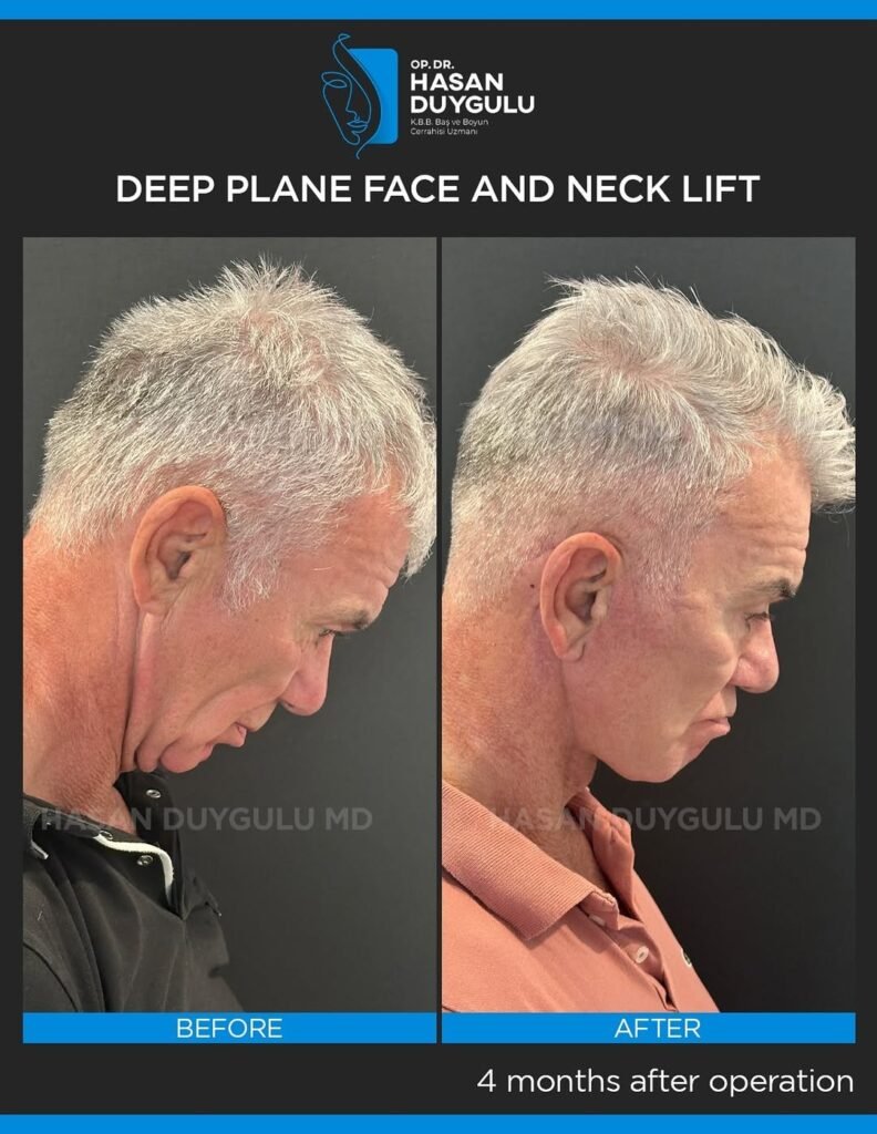 This-patient-consulted-me-4-months-ago-for-facial-rejuvenation-surgery.We-performed-deep-plane-f-3