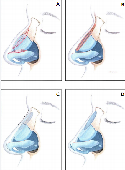 Pollybeak (Supratip) Deformity 
