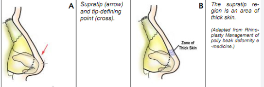 Pollybeak (Supratip) Deformity 