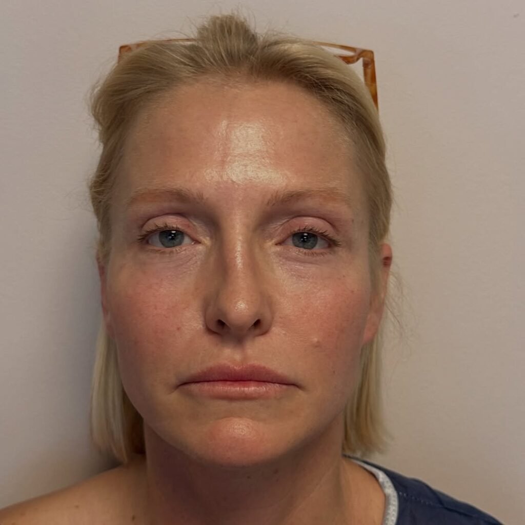 Lip Lift in Turkey lip-lift-fox-eyes-1