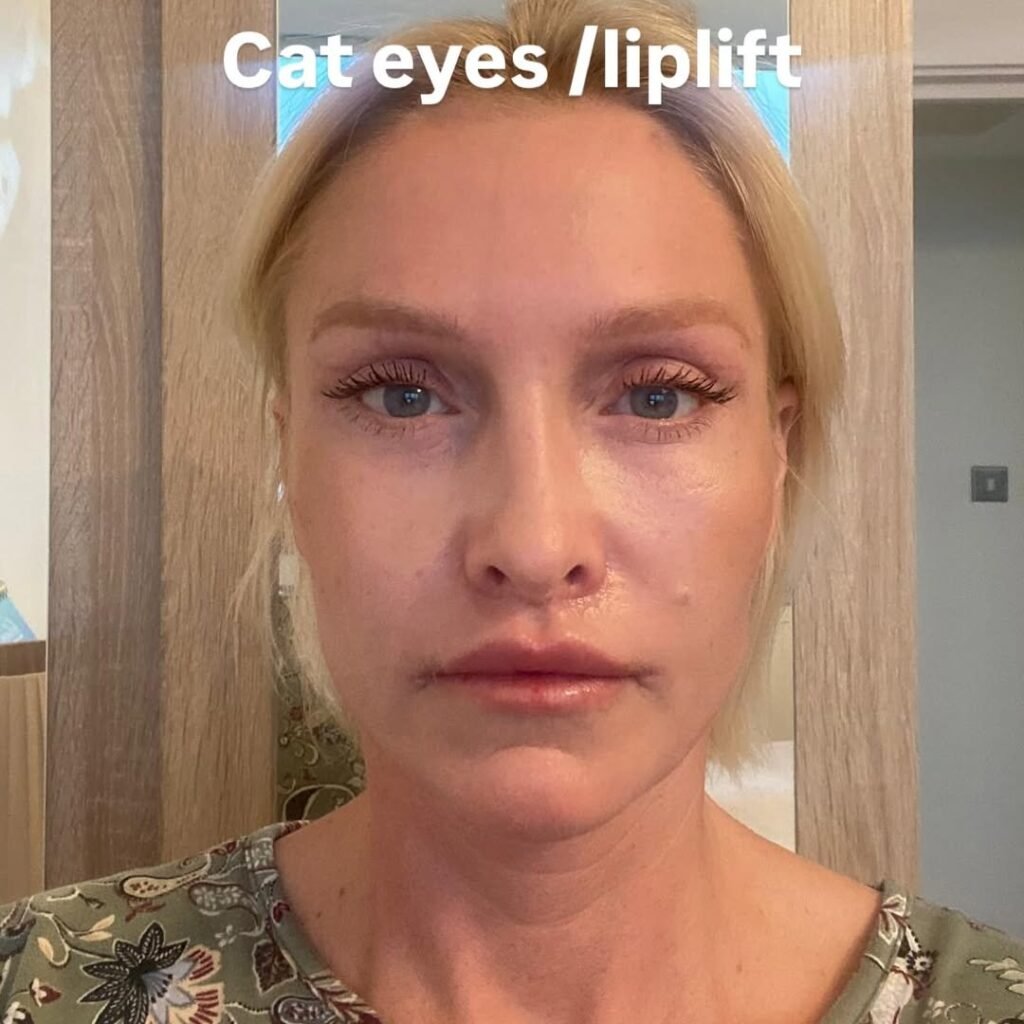 Lip Lift in Turkey lip-lift-fox-eyes-2