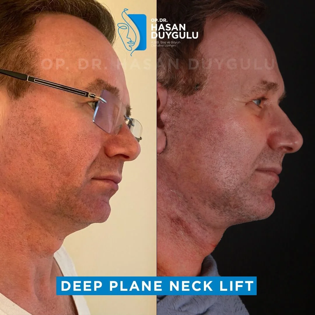 Neck Lift 2