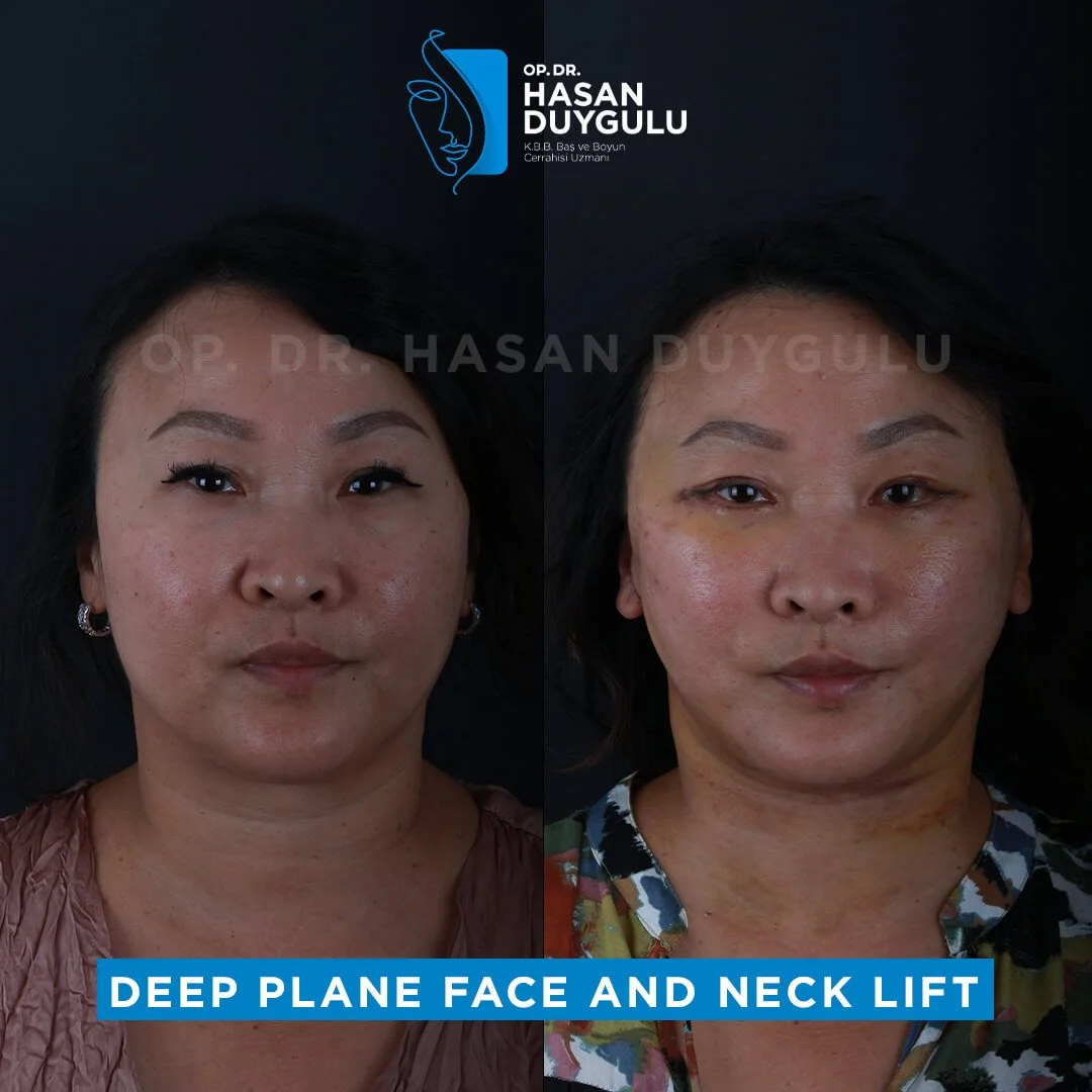 Neck Lift 4