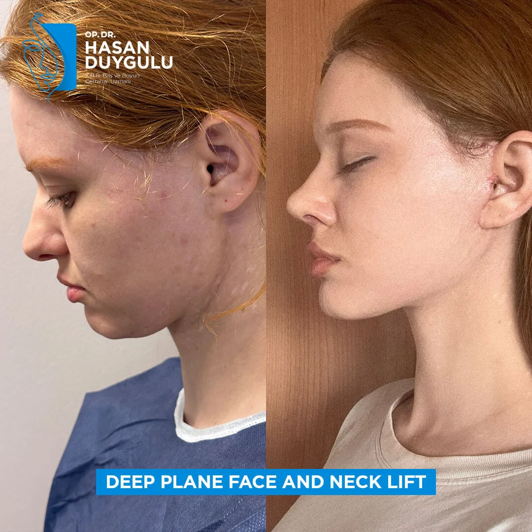 Neck Lift 1