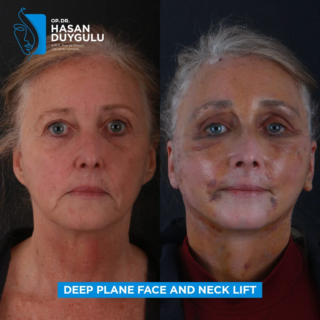 Neck Lift 5