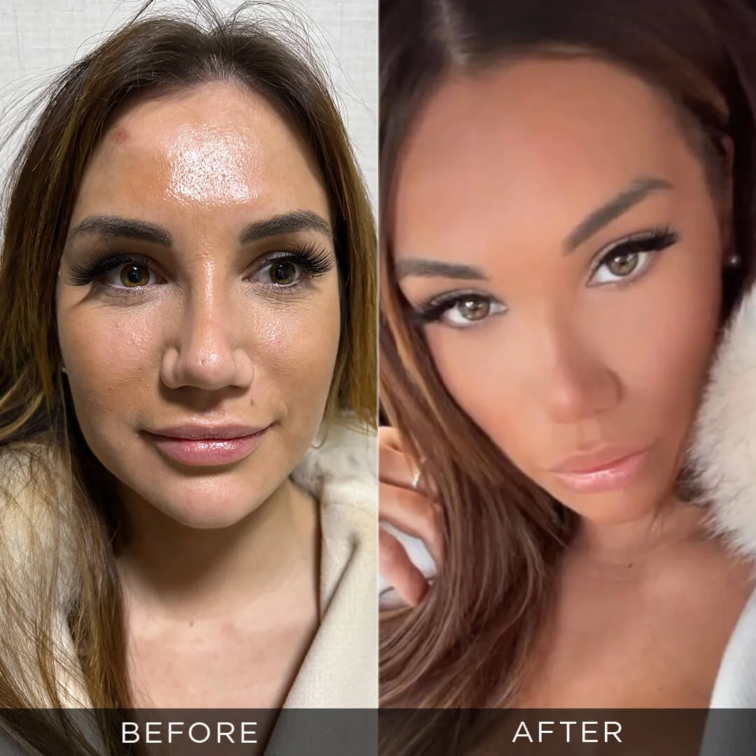 Eyelid Surgery 1
