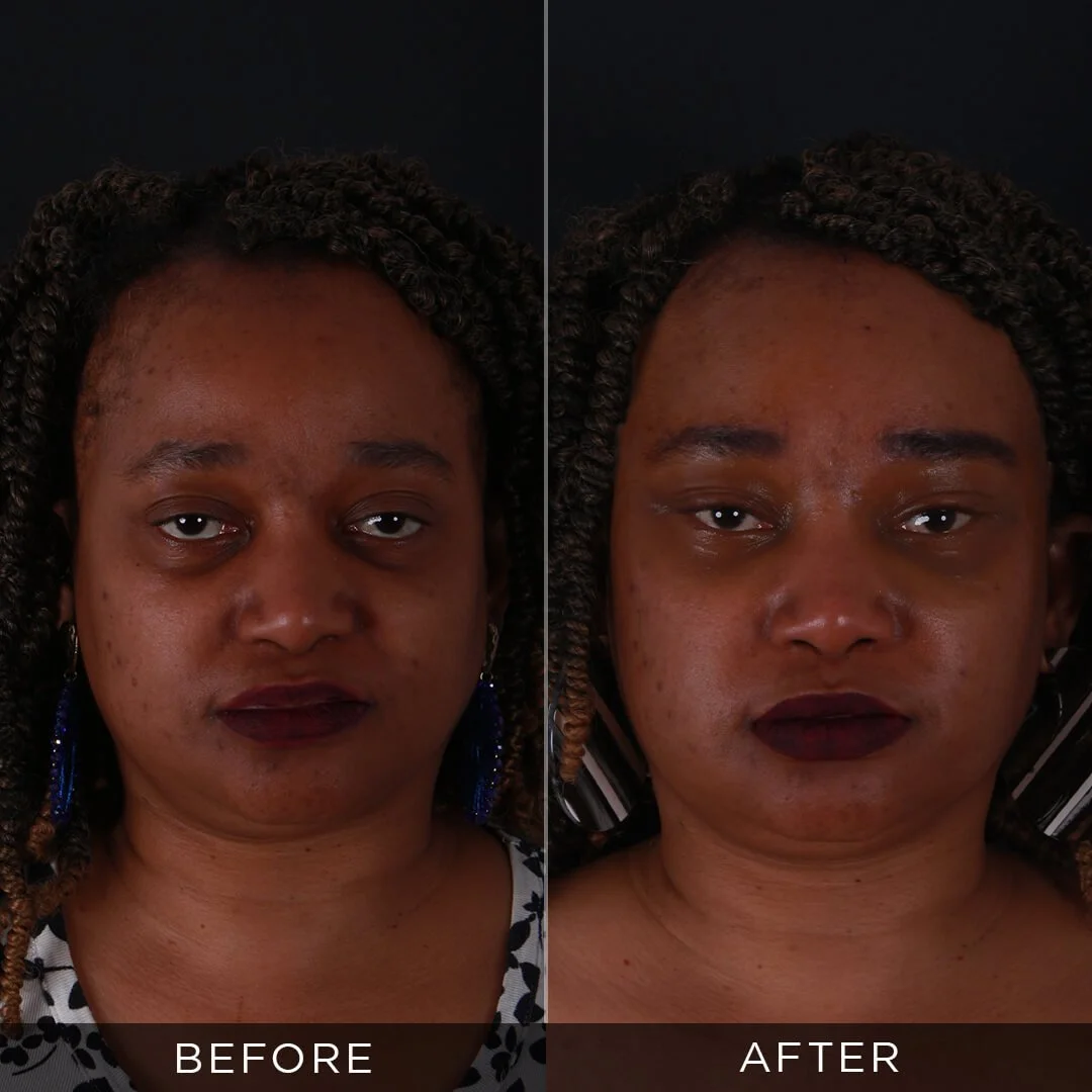 Eyelid Surgery 4