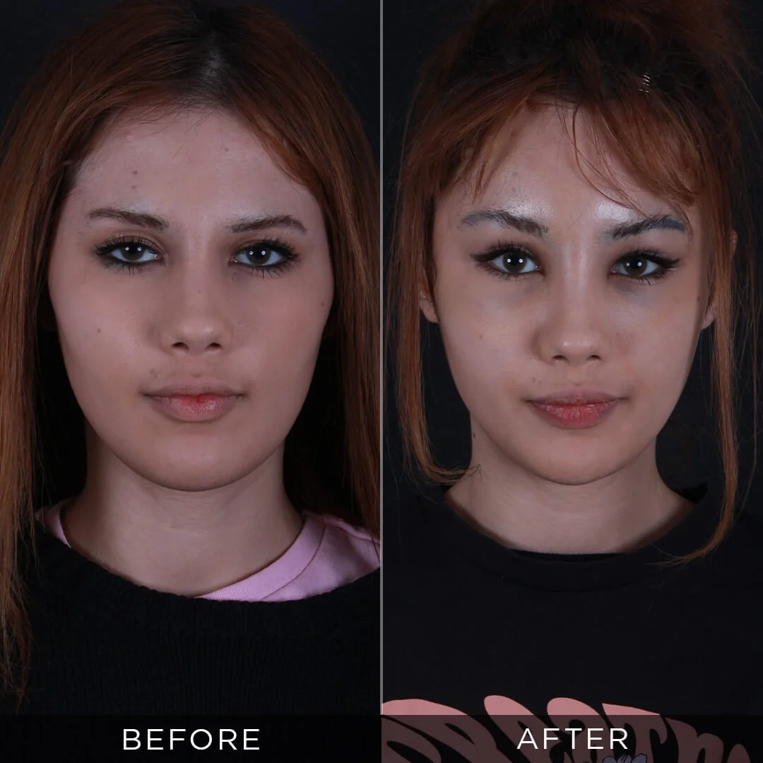 Eyelid Surgery 2