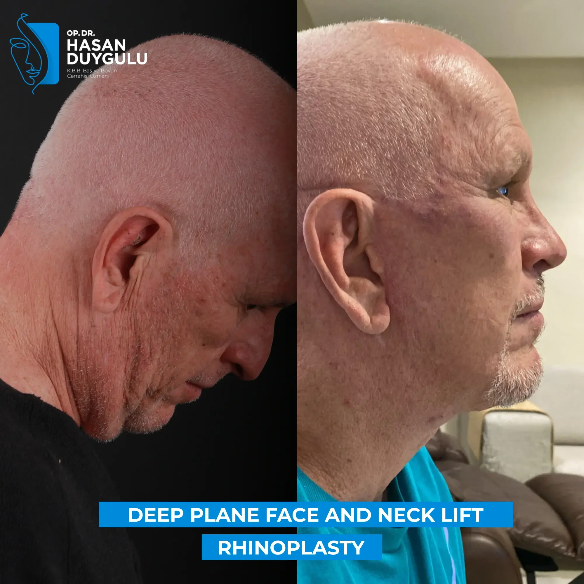 Neck Lift 3